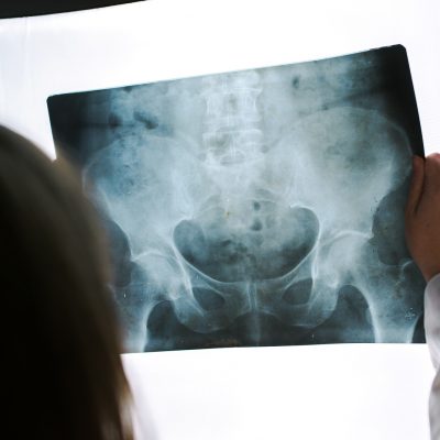 Female doctor examining pelvis x-ray in hospital office medical professional in white uniform analyzing hip image in clinic.