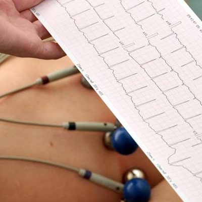ekg