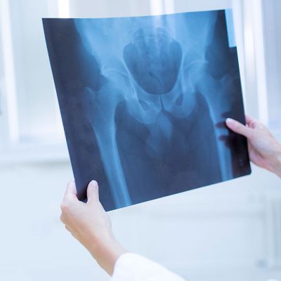 simptomy-i-diagnostika-pereloma-podvzdoshnoj-kosti